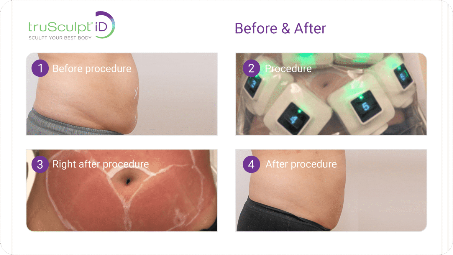 truSculpt vs. CoolSculpting Which is better? BYou Laser Clinic